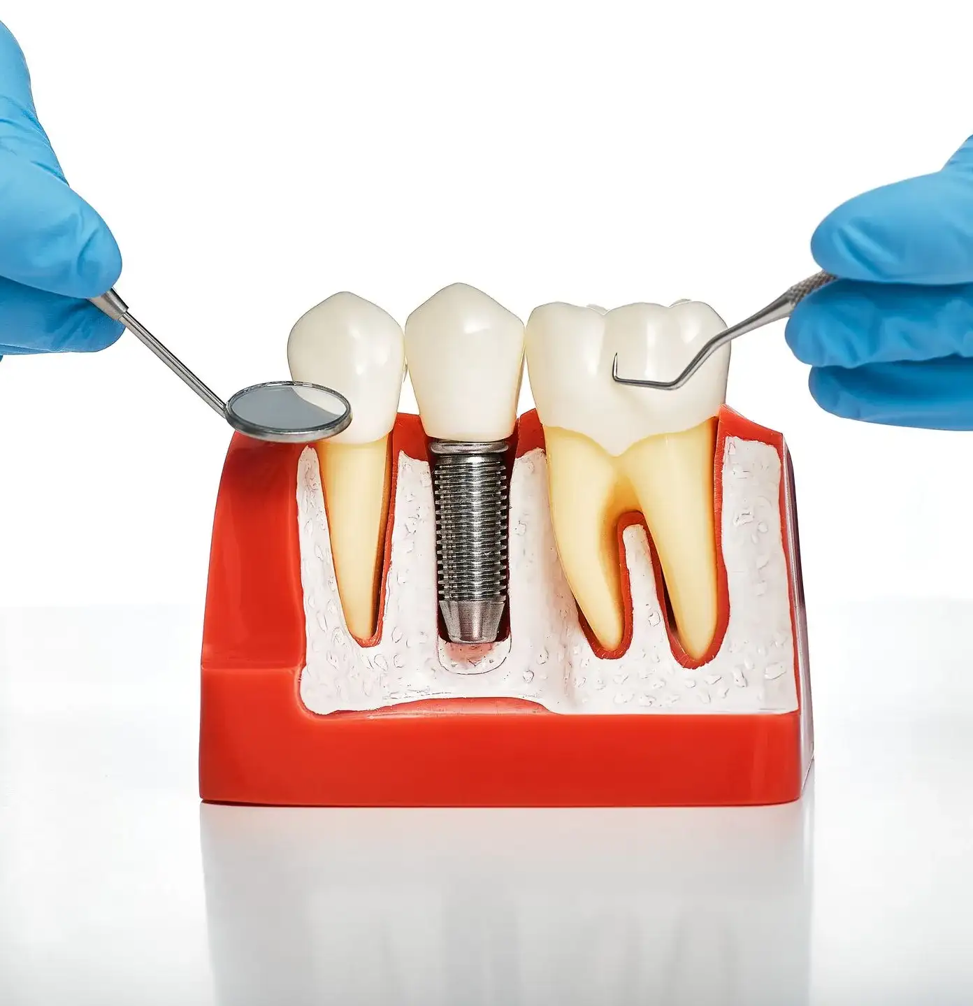 2 Descrião Implantolologia