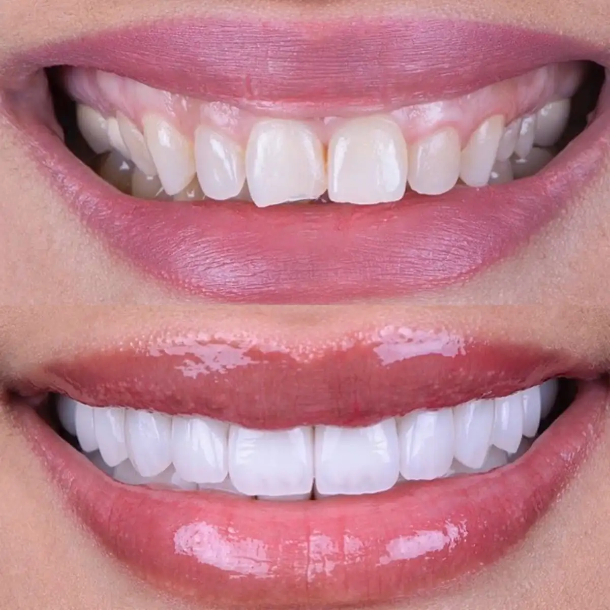 Descrição Faceta Dentaria